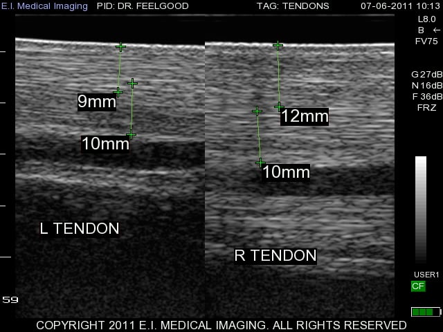 tendon comparative measurement